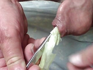 Combination Spring And Scissors In Foreskin...