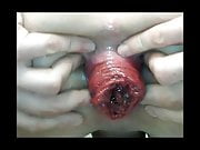 Prolapse close up 1